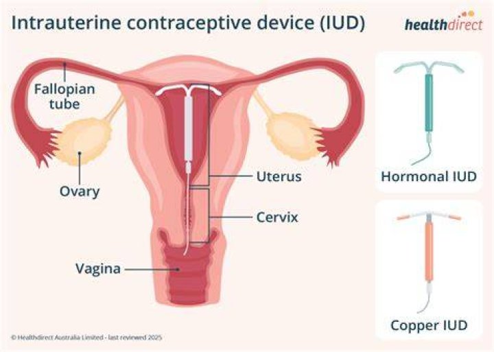 Why Is The Mirena IUD Being Recalled? - Important Information You Need to Know