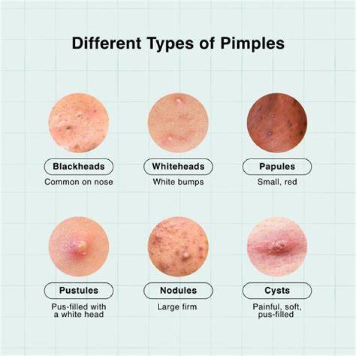 Why You Have Pimples on Your Balls—and How to Get Rid of Them