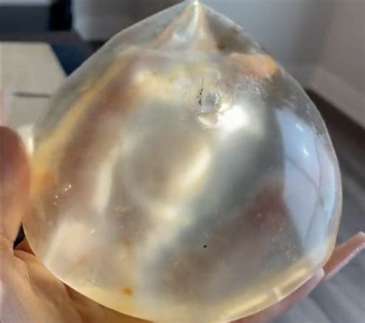 Woman reveals moldy breast implants after lifechanging removal En