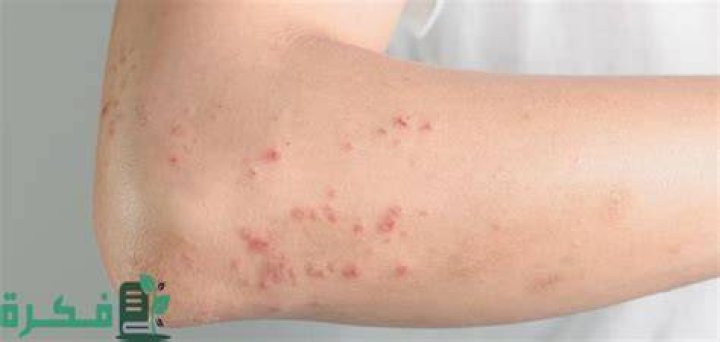 علاج الحساسية في الكلاب؛ أسبابها وأعراضها وأهم 4 طرق لعلاجها