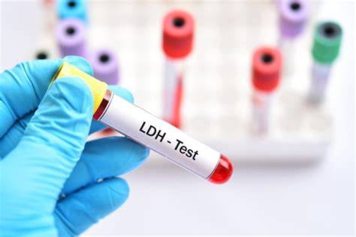 ما هو تحليل LDH - موقع فكرة