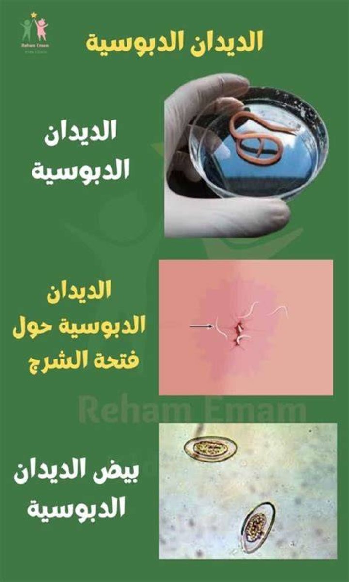 هل الديدان الدبوسية تسبب العقم